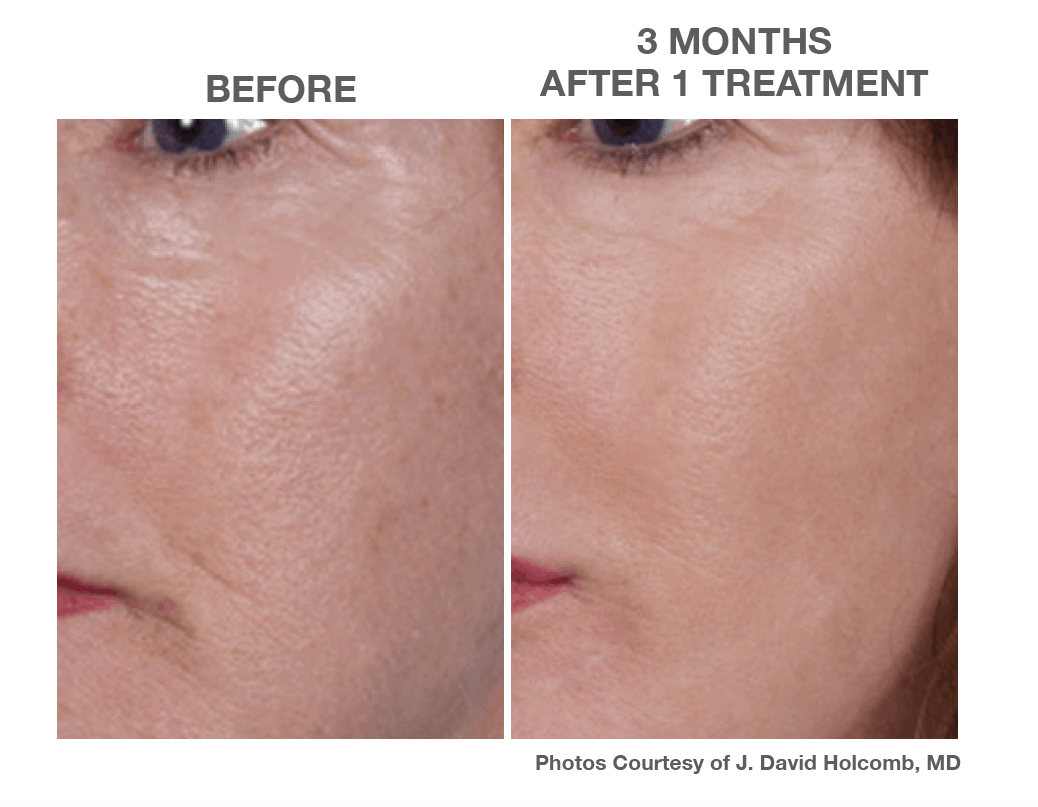 3 Months after 1 Treatments of Nano Laser Peel Skin Resurfing