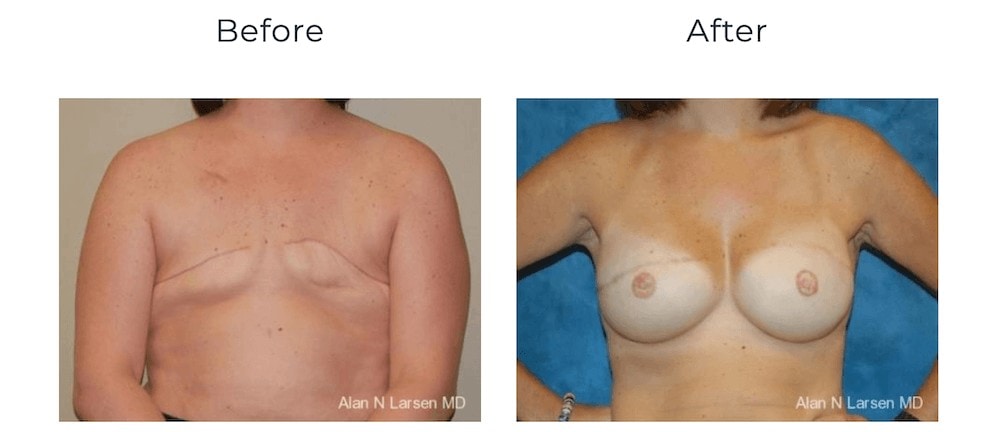 breast reconstruction breast cancer awareness