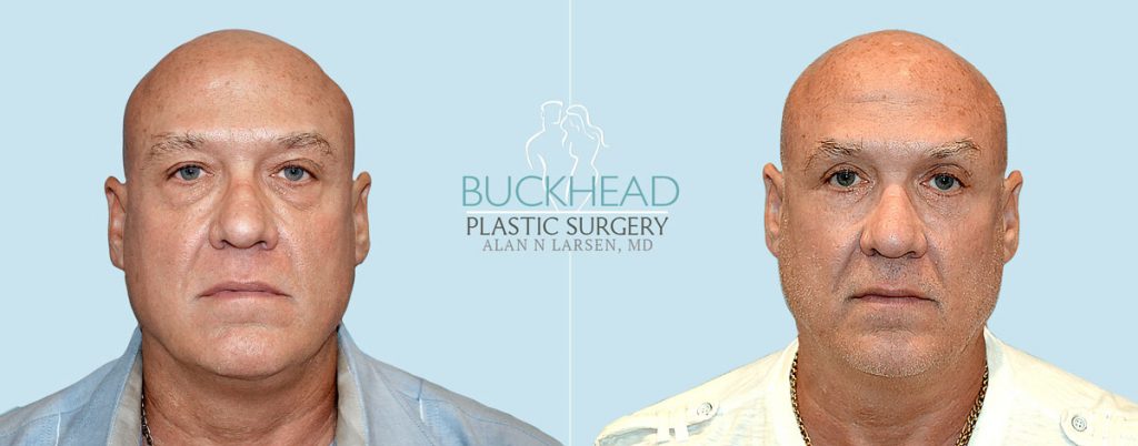 Buckhead Plastic Surgery, explains why patients want an eyelid lift surgery aka a blepharoplasty, to help refresh tired-looking eyes.
