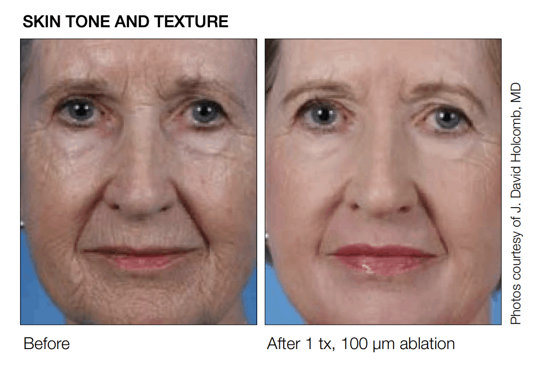 SCITON before and after results for micro laser contour peel at lux med spa atlanta DEEP RESURFACING