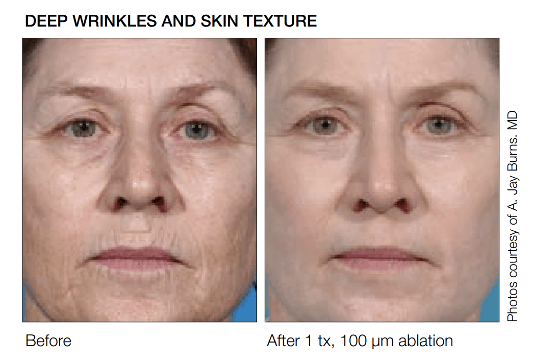 SCITON before and after results for micro laser contour peel at lux med spa atlanta DEEP RESURFACING