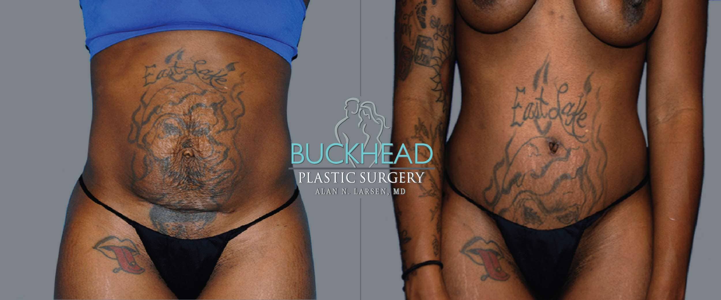 Before and After Photo gallery | Tummy Tuck | Buckhead Plastic Surgery | Board-Certified Plastic Surgeon in Atlanta GA