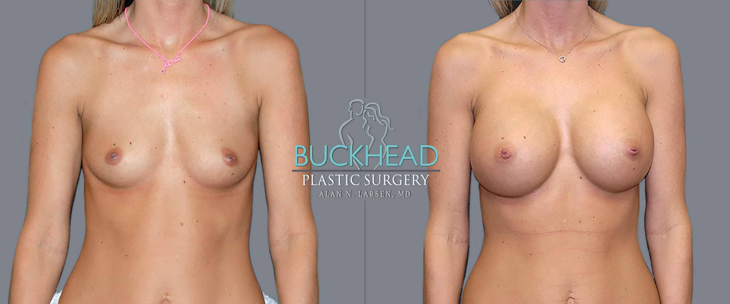 Before and After Photo gallery | Breast Augmentation | Buckhead Plastic Surgery | Board-Certified Plastic Surgeon in Atlanta GA