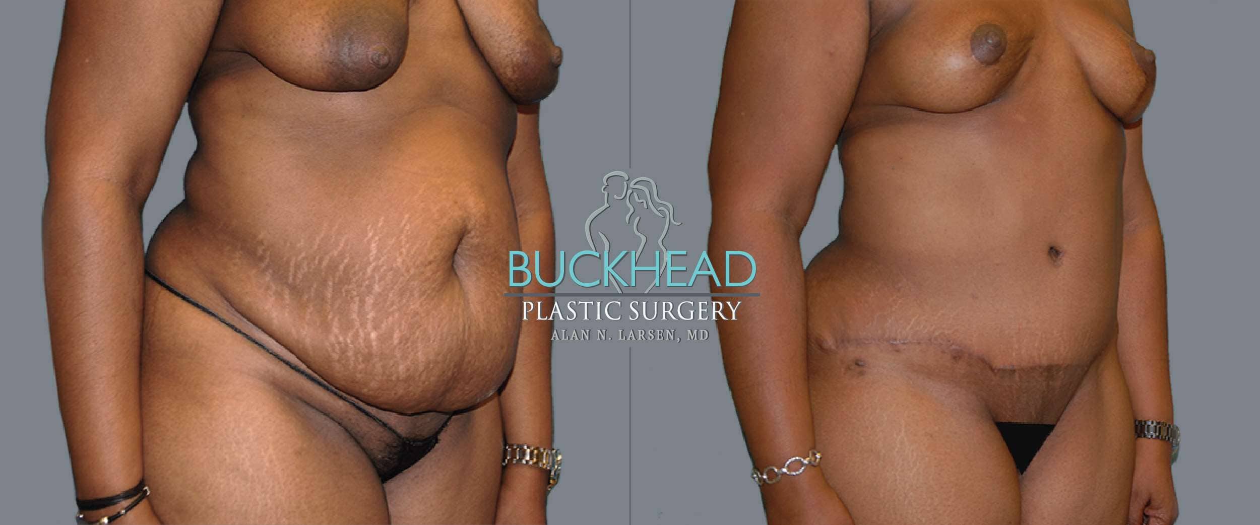 Before and After Photo gallery | Tummy Tuck | Buckhead Plastic Surgery | Double Board-Certified Plastic Surgeon in Atlanta GA