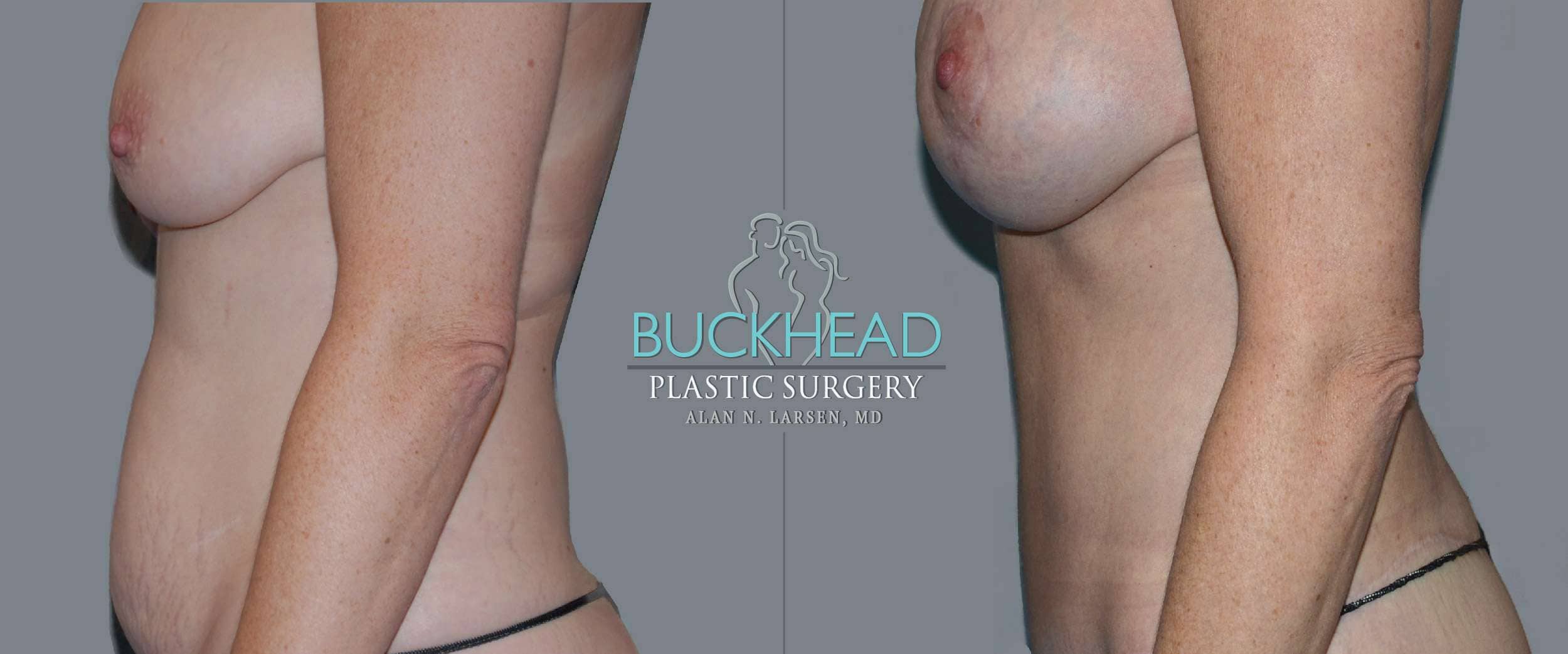 Before and After Photo Gallery | Liposuction | Buckhead Plastic Surgery | Alan N. Larsen, MD | Board-Certified Plastic Surgeon | Atlanta GA