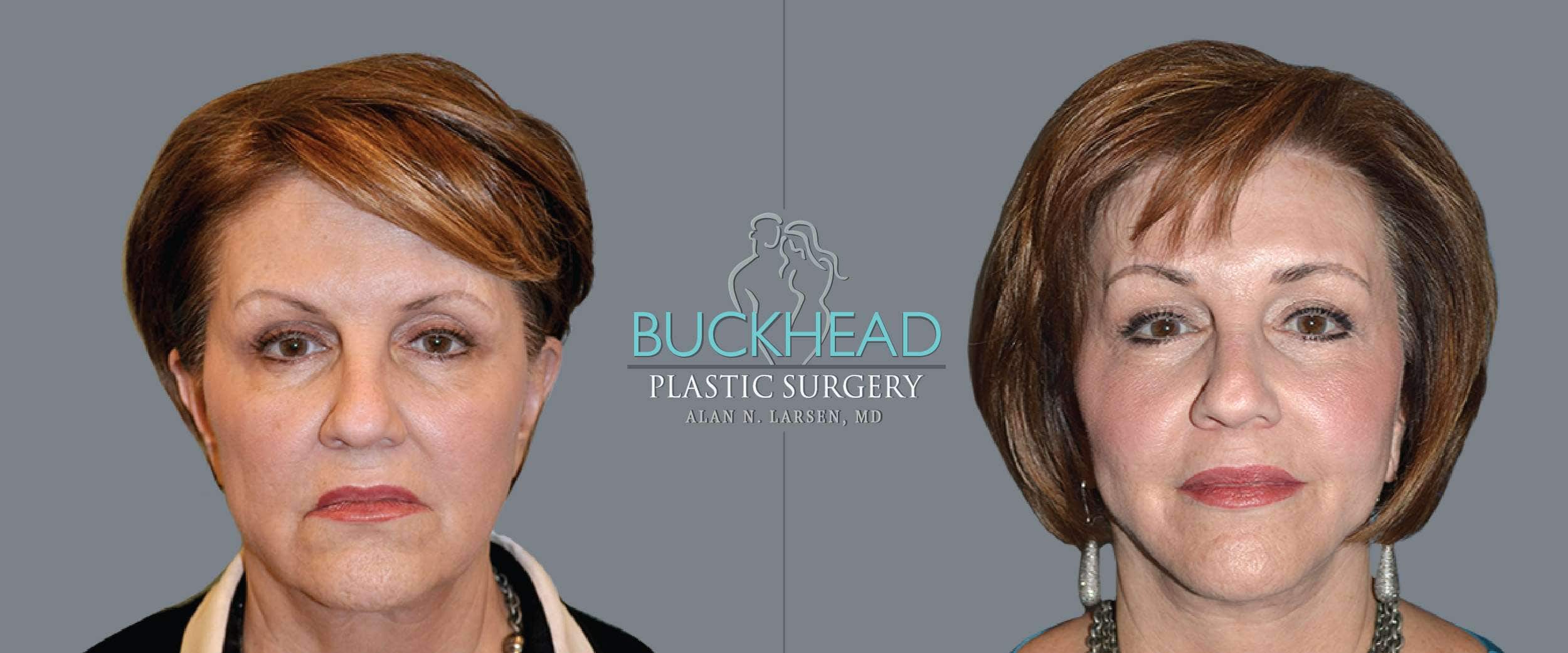 Before and After Photo Gallery | Blepharosty | Buckhead Plastic Surgery | Alan N. Larsen, MD | Board-Certified Plastic Surgeon | Atlanta GA