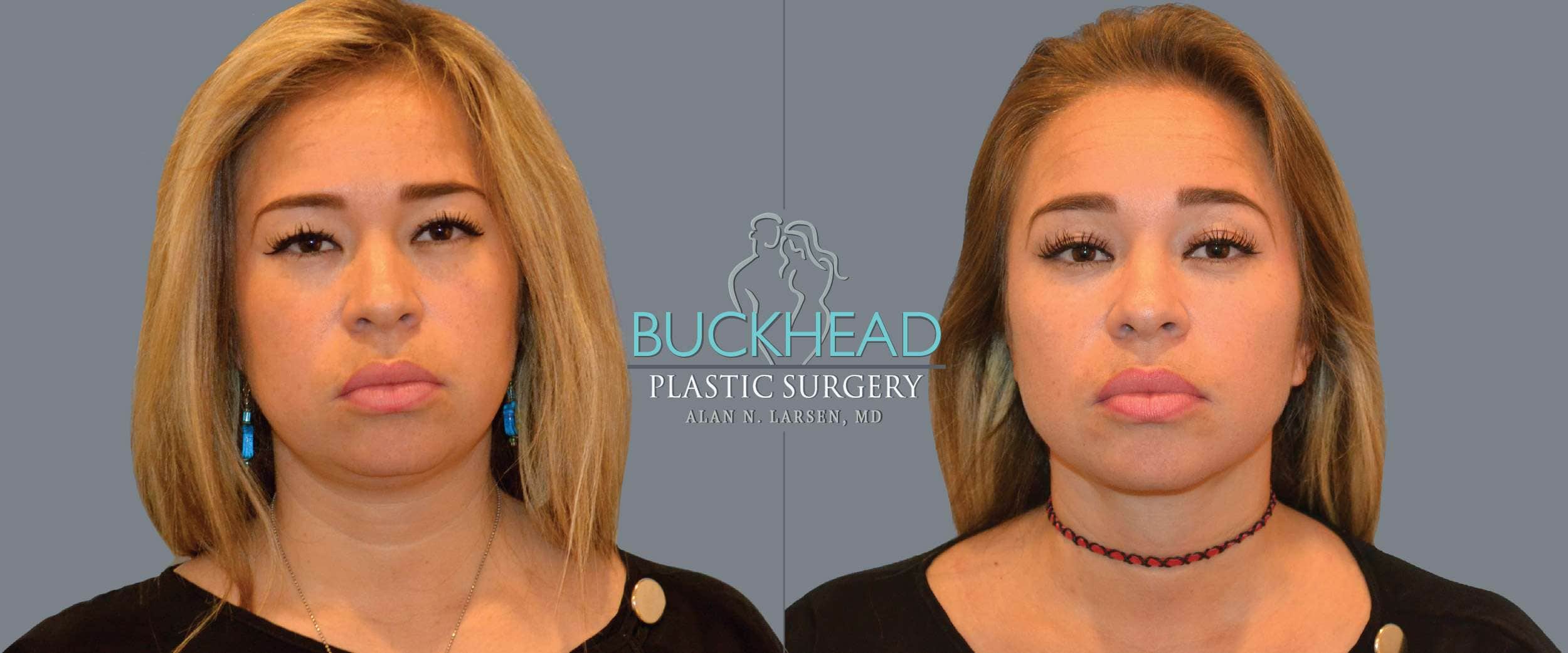 Before and After Photo Gallery | Liposuction - Neck | Buckhead Plastic Surgery | Alan N. Larsen, MD | Board-Certified Plastic Surgeon | Atlanta GA