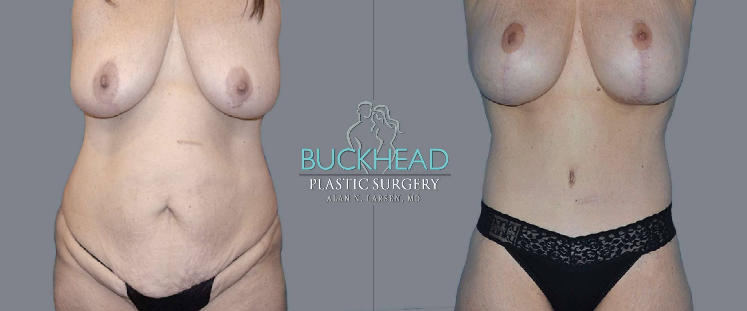 Before and After Photo gallery | Body Lift | Buckhead Plastic Surgery | Double Board-Certified Plastic Surgeon in Atlanta GA
