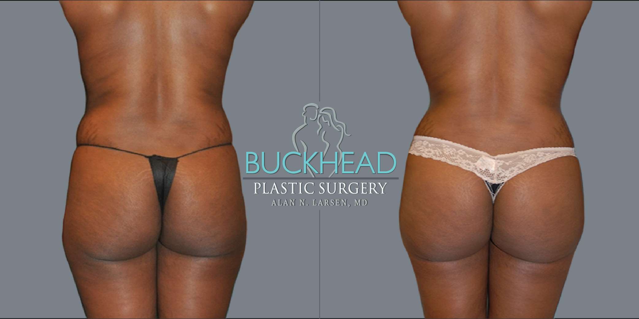 Before and After Photo gallery | Brazilian Butt Lift | Buckhead Plastic Surgery | Double Board-Certified Plastic Surgeon in Atlanta GA