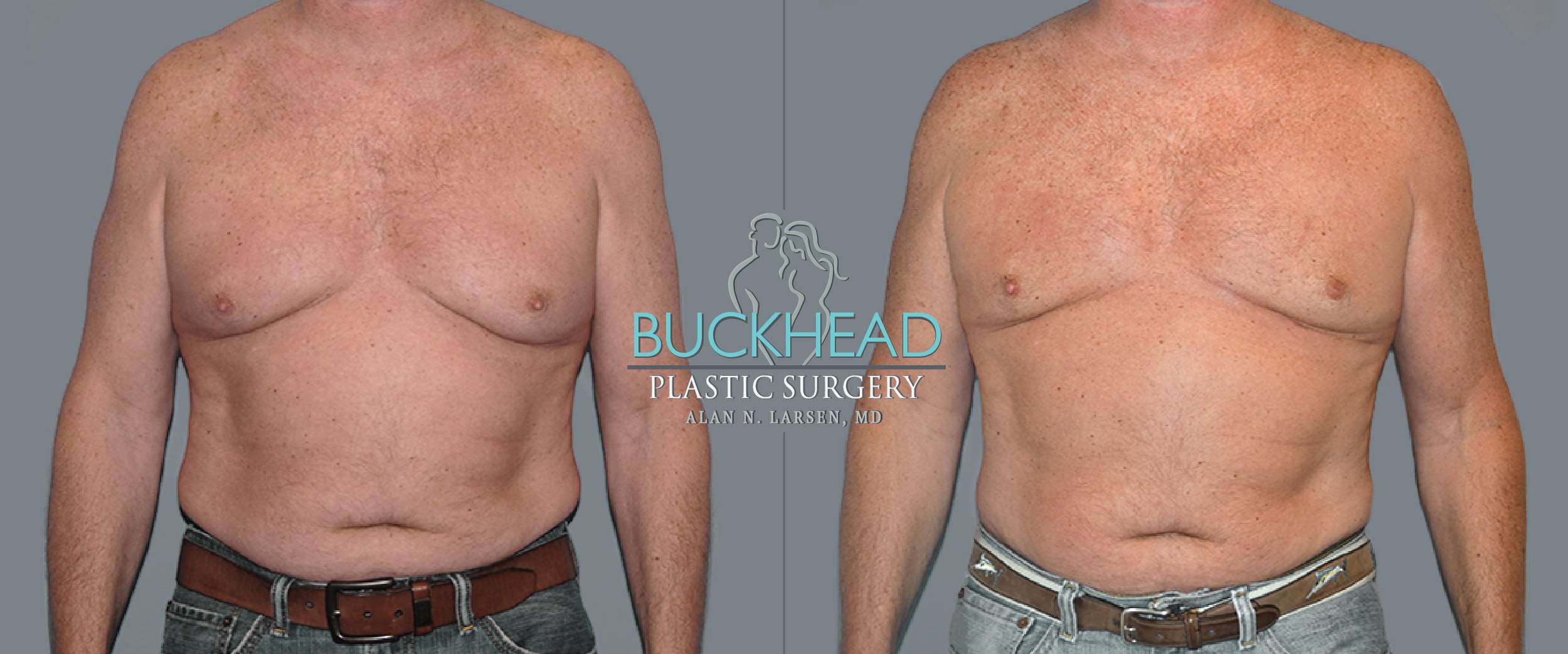 Before and After Photo Gallery | Gynecomastia - Male Breast Reduction & Correction | Buckhead Plastic Surgery | Board-Certified Plastic Surgeon in Atlanta GA
