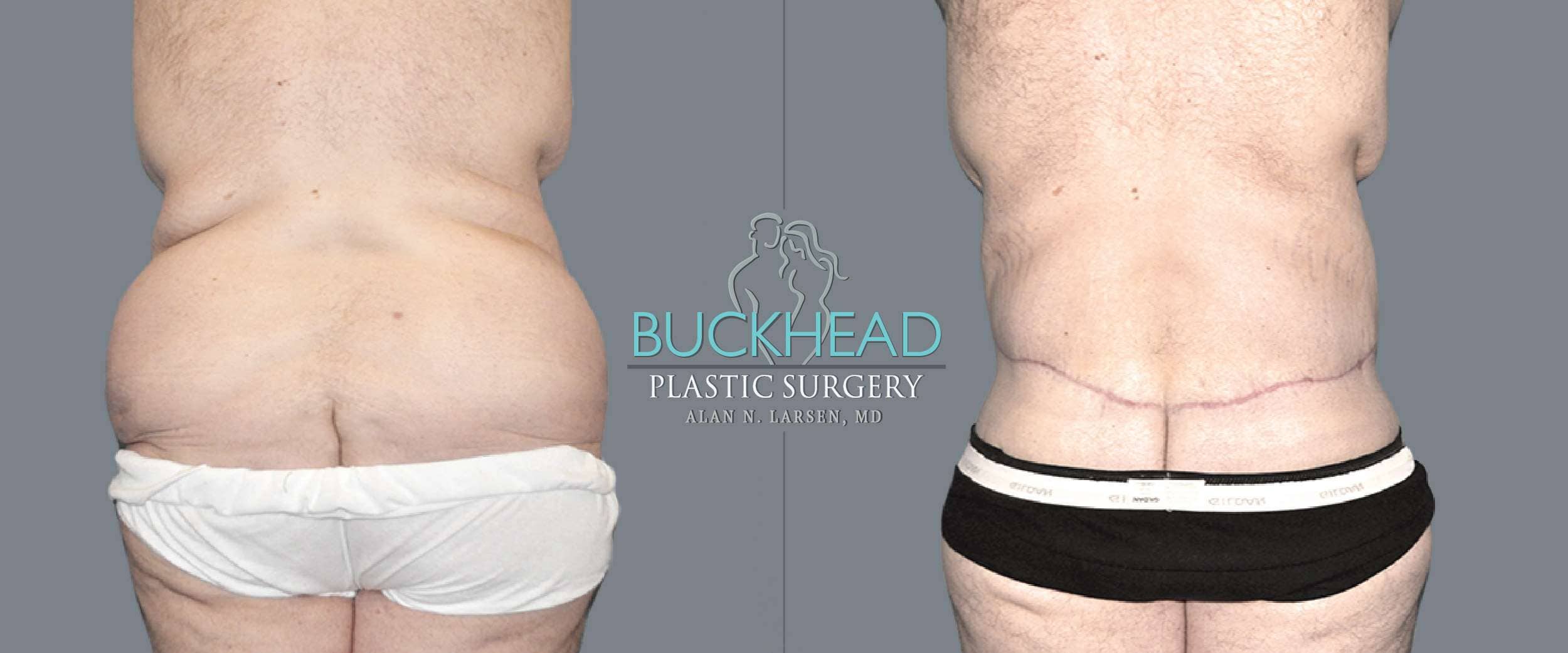 Before and After Photo gallery | Body Lift | Buckhead Plastic Surgery | Board-Certified Plastic Surgeon in Atlanta GA