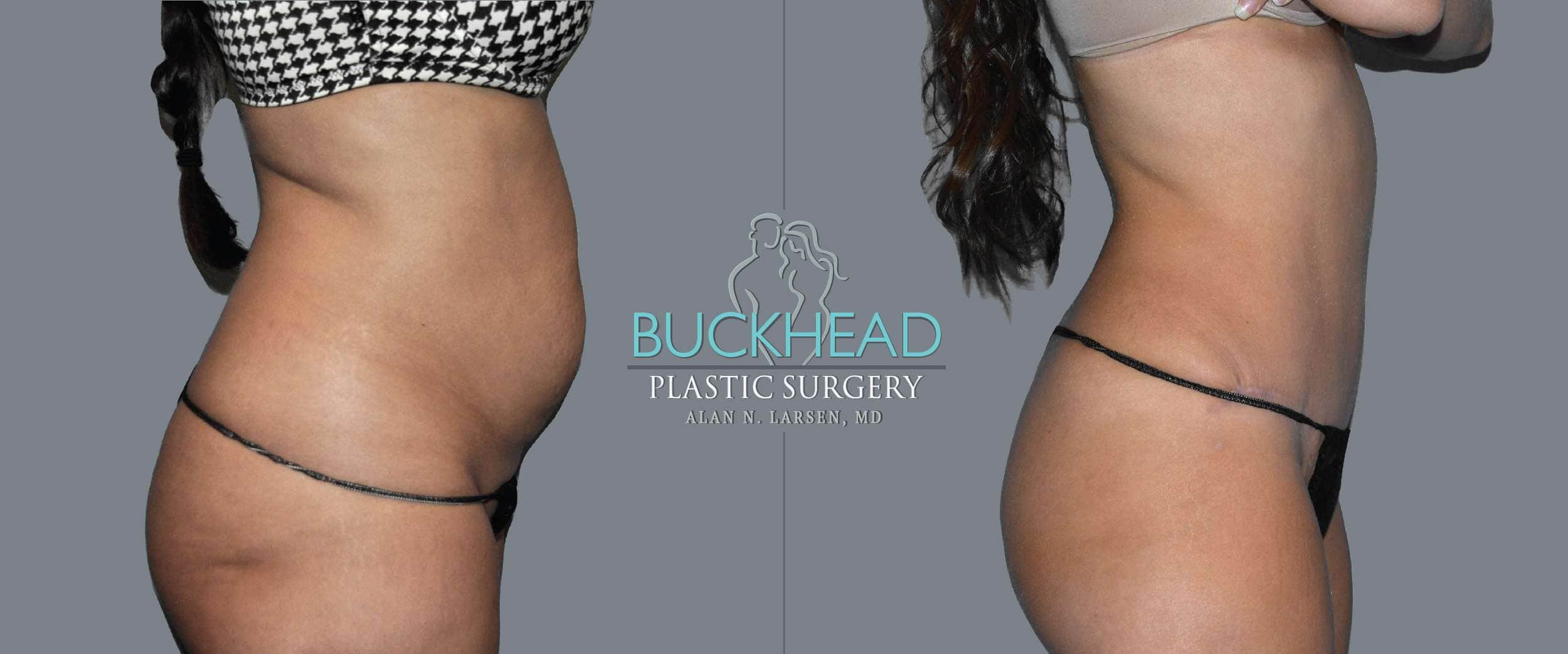 Before and After Photo Gallery | Liposuction - Hips & Flanks | Buckhead Plastic Surgery | Alan N. Larsen, MD | Double Board-Certified Plastic Surgeon | Atlanta GA
