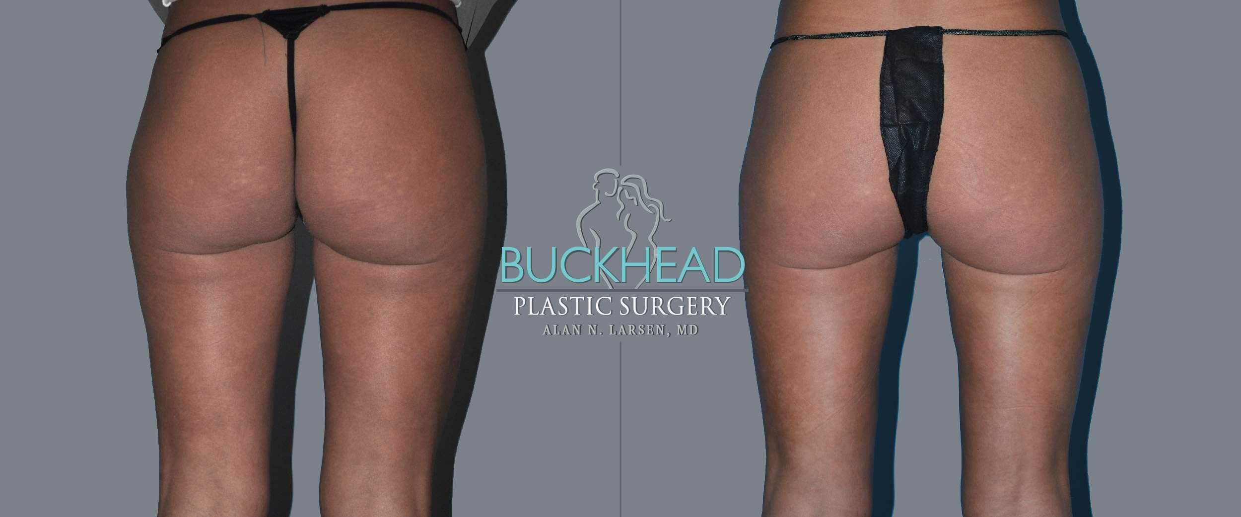 Before and After Photo Gallery | Liposuction - Thigh Back | Buckhead Plastic Surgery | Alan N. Larsen, MD | Board-Certified Plastic Surgeon | Atlanta GA