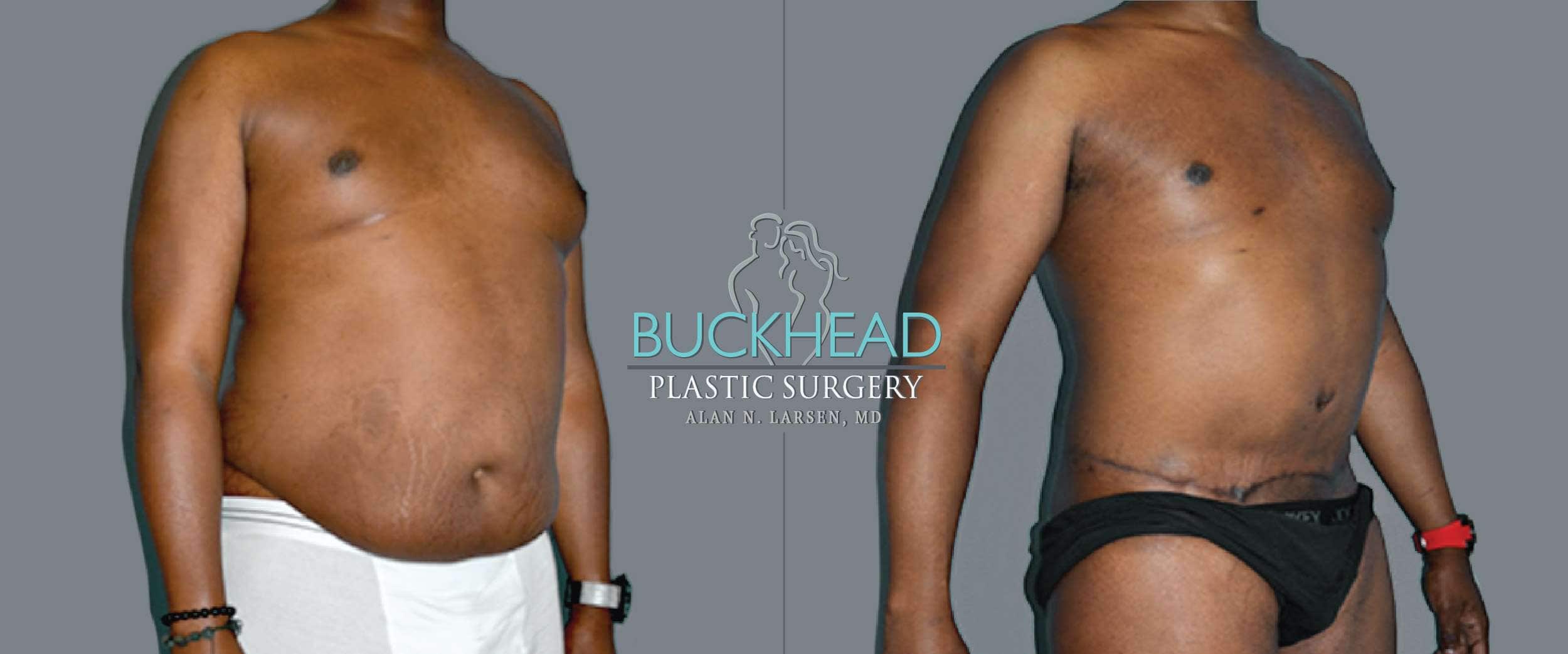 Before and After Photo Gallery | Gynecomastia - Male Breast Reduction & Correction | Buckhead Plastic Surgery | Board-Certified Plastic Surgeon in Atlanta GA