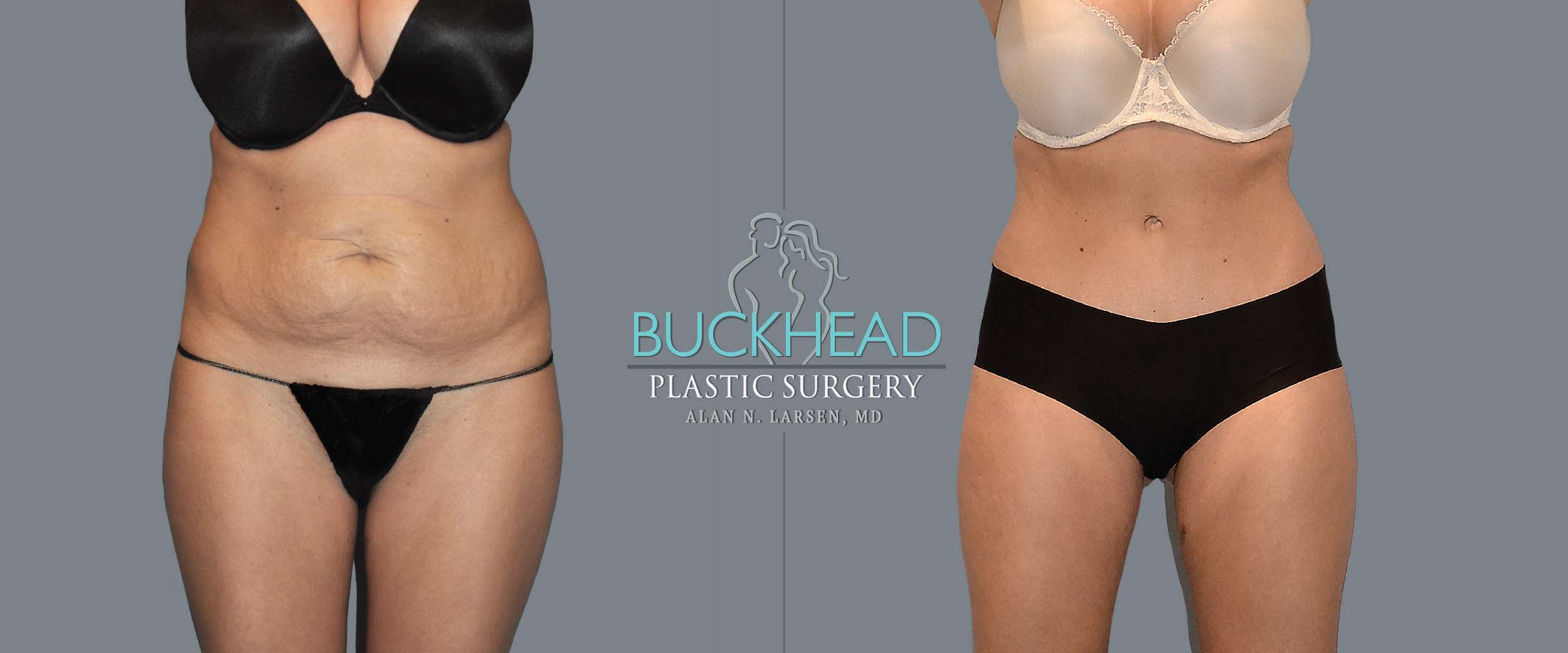 Before and After Photo Gallery | Liposuction - Hips & Flanks | Buckhead Plastic Surgery | Alan N. Larsen, MD | Board-Certified Plastic Surgeon | Atlanta GA