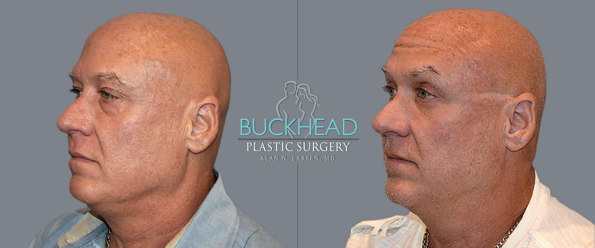 Before and After Photo Gallery | Blepharosty | Buckhead Plastic Surgery | Alan N. Larsen, MD | Board-Certified Plastic Surgeon | Atlanta GA