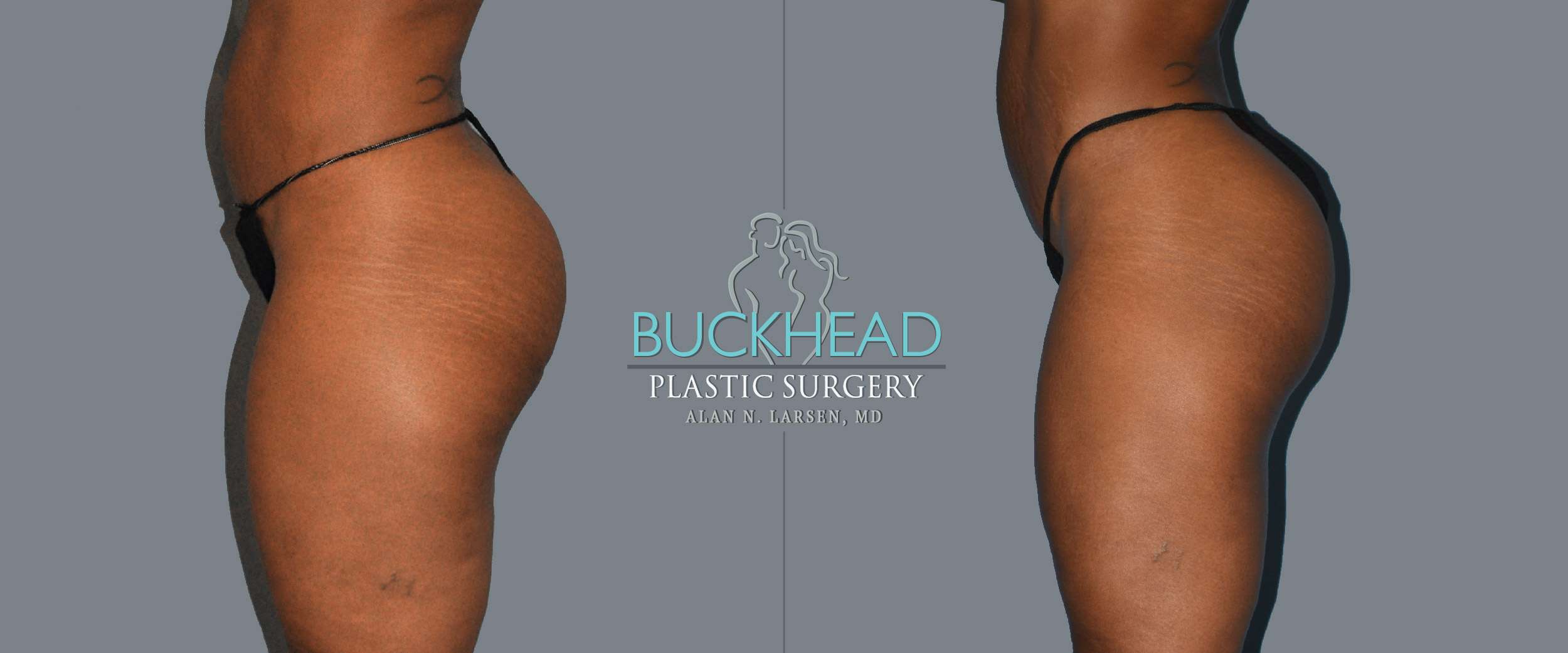 Before and After Photo Gallery | Liposuction - Thigh Front | Buckhead Plastic Surgery | Alan N. Larsen, MD | Board-Certified Plastic Surgeon | Atlanta GA