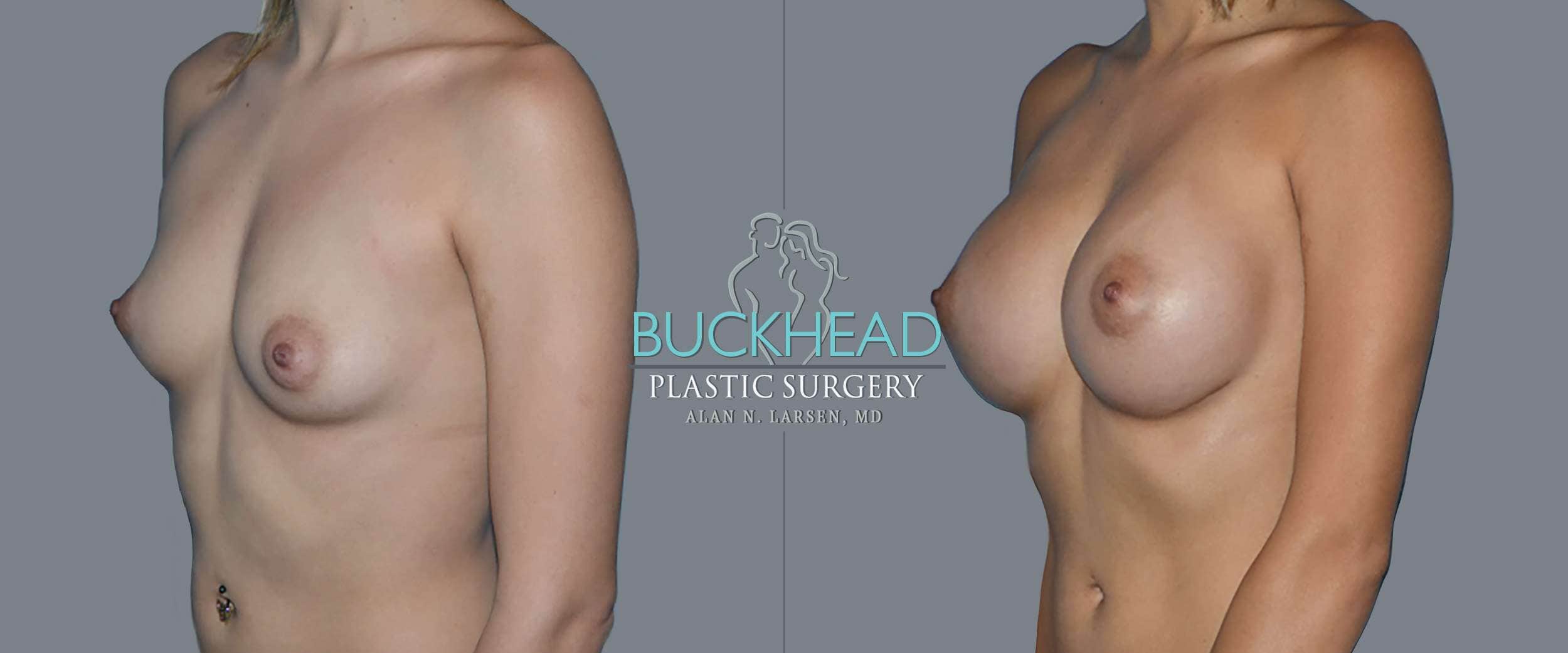 Before and After Photo Gallery | Breast Augmentation | Buckhead Plastic Surgery | Alan N. Larsen, MD | Double Board-Certified Plastic Surgeon in Atlanta GA