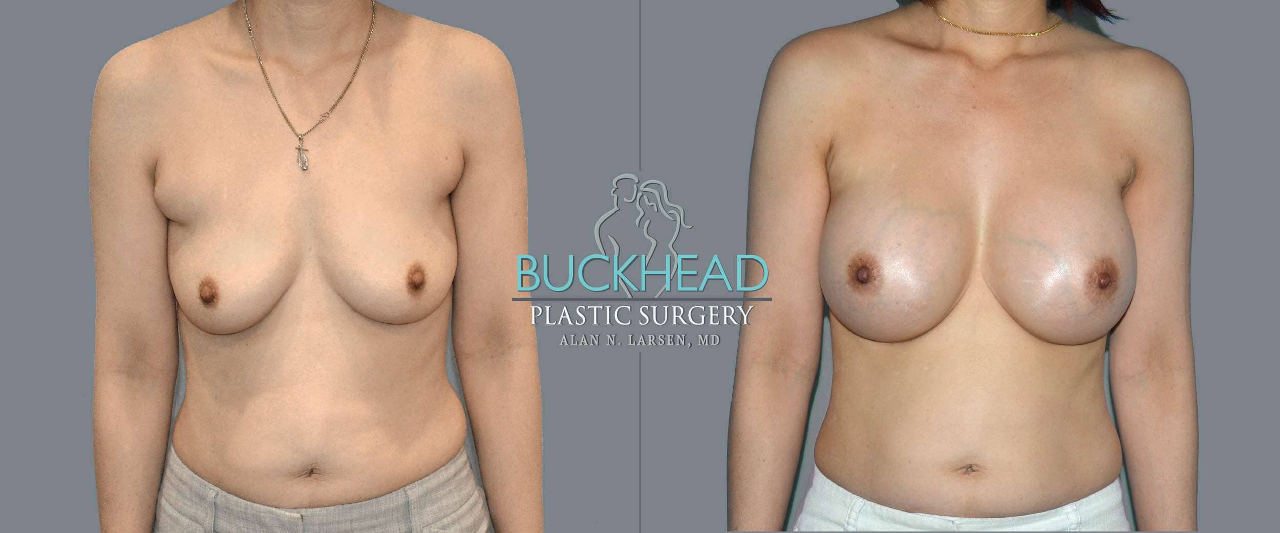 Before and After Photo Gallery | Liposuction | Buckhead Plastic Surgery | Alan N. Larsen, MD | Board-Certified Plastic Surgeon | Atlanta GA