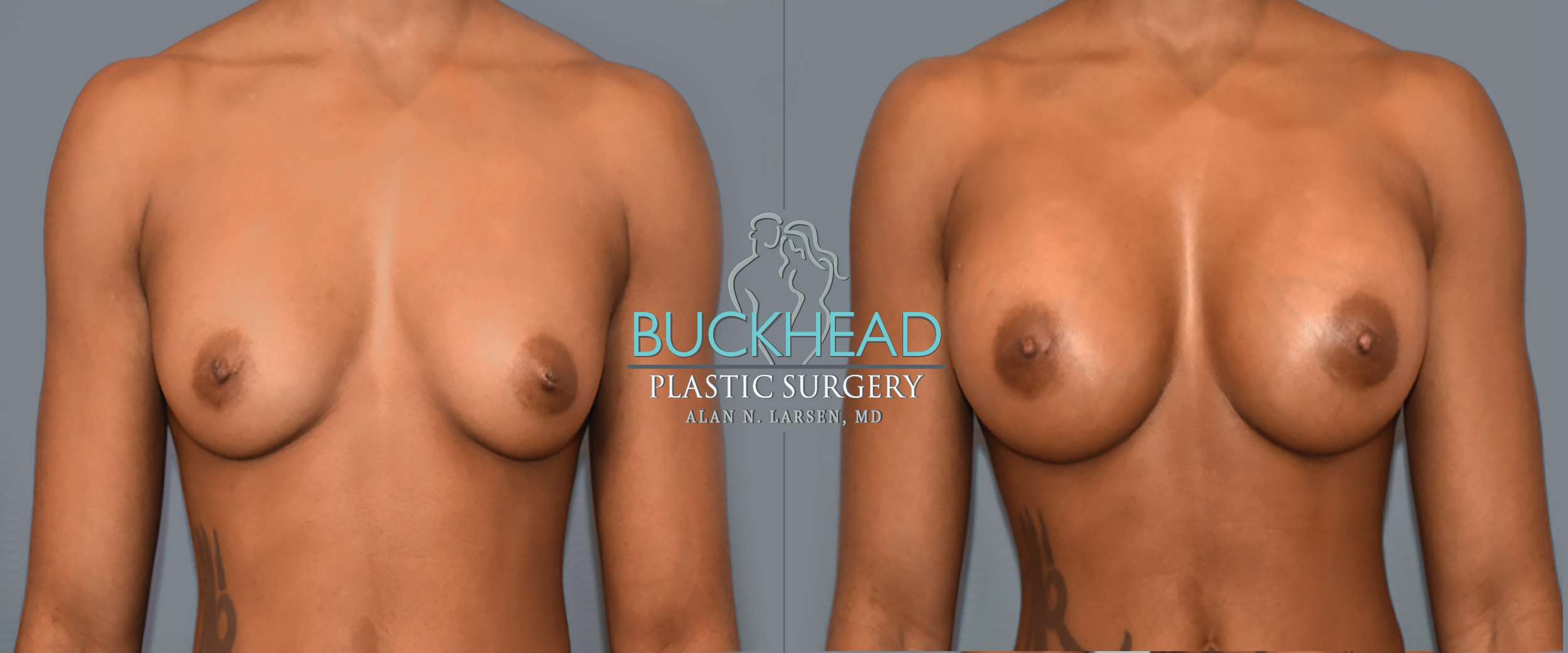 Before and After Photo Gallery | Breast Augmentation | Buckhead Plastic Surgery | Alan N. Larsen, MD | Double Board-Certified Plastic Surgeon in Atlanta GA