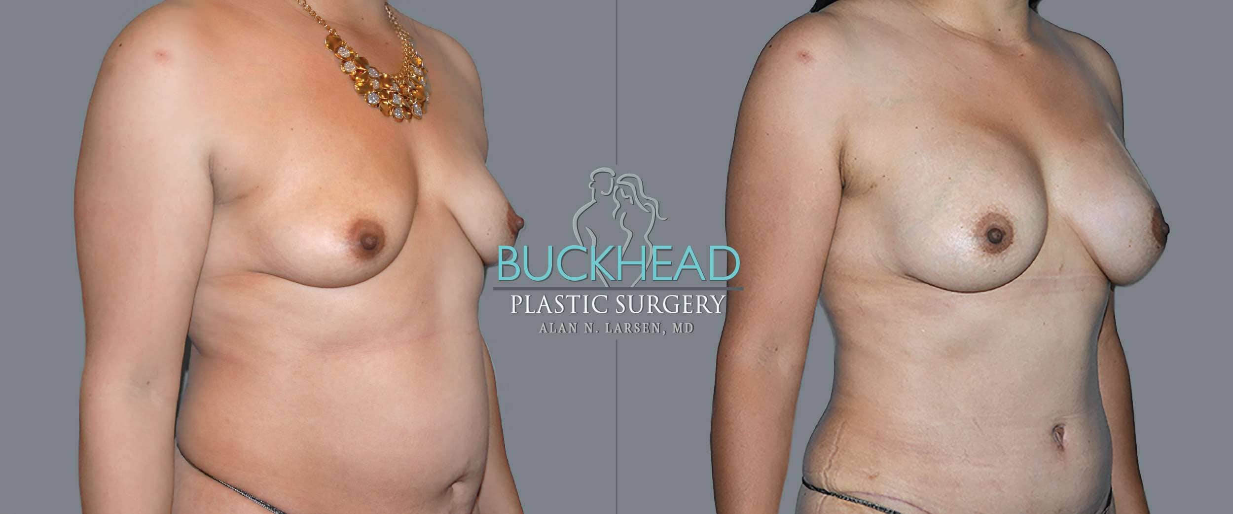 Before and After Photo Gallery | Breast Augmentation | Buckhead Plastic Surgery | Double Board-Certified Plastic Surgeon in Atlanta GA
