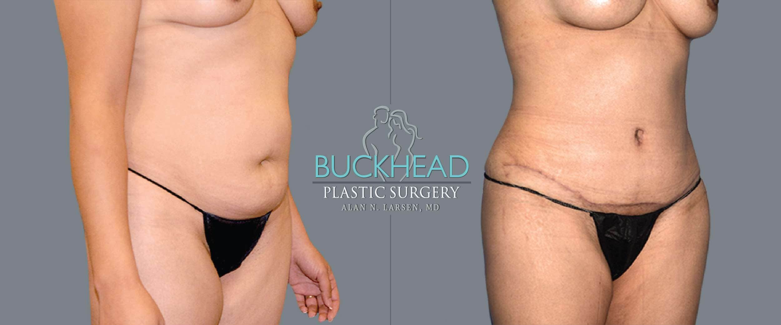 Before and After Photo gallery | Tummy Tuck | Buckhead Plastic Surgery | Board-Certified Plastic Surgeon in Atlanta GA