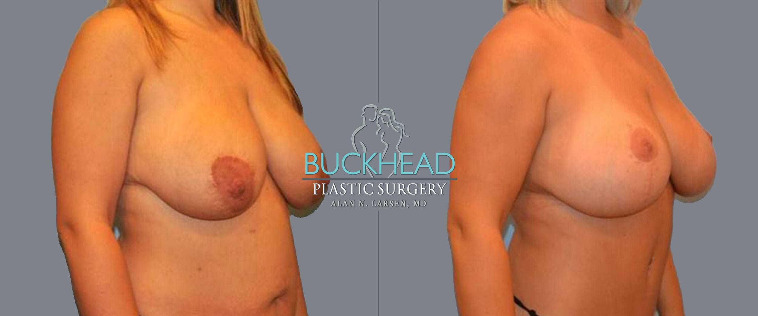 Before and After Photo Gallery | Breast Lift | Buckhead Plastic Surgery | Alan N. Larsen, MD | Board-Certified Plastic Surgeon | Atlanta GA