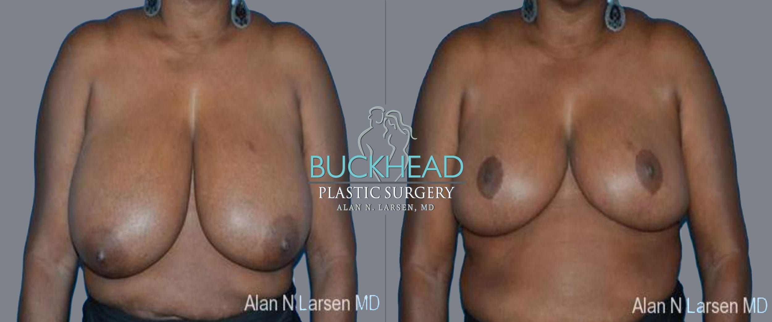 Before and After Photo Gallery | Breast Reduction | Buckhead Plastic Surgery | Alan N. Larsen, MD | Board-Certified Plastic Surgeon | Atlanta GA