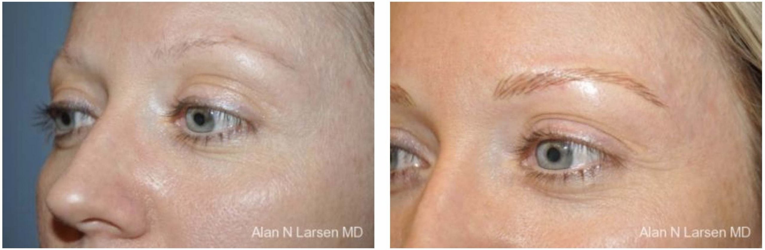 LUX Med Spa at Before and After Photo Gallery | Microblading | Buckhead Plastic Surgery | Alan N. Larsen, MD | Board-Certified Plastic Surgeon | Atlanta GA
