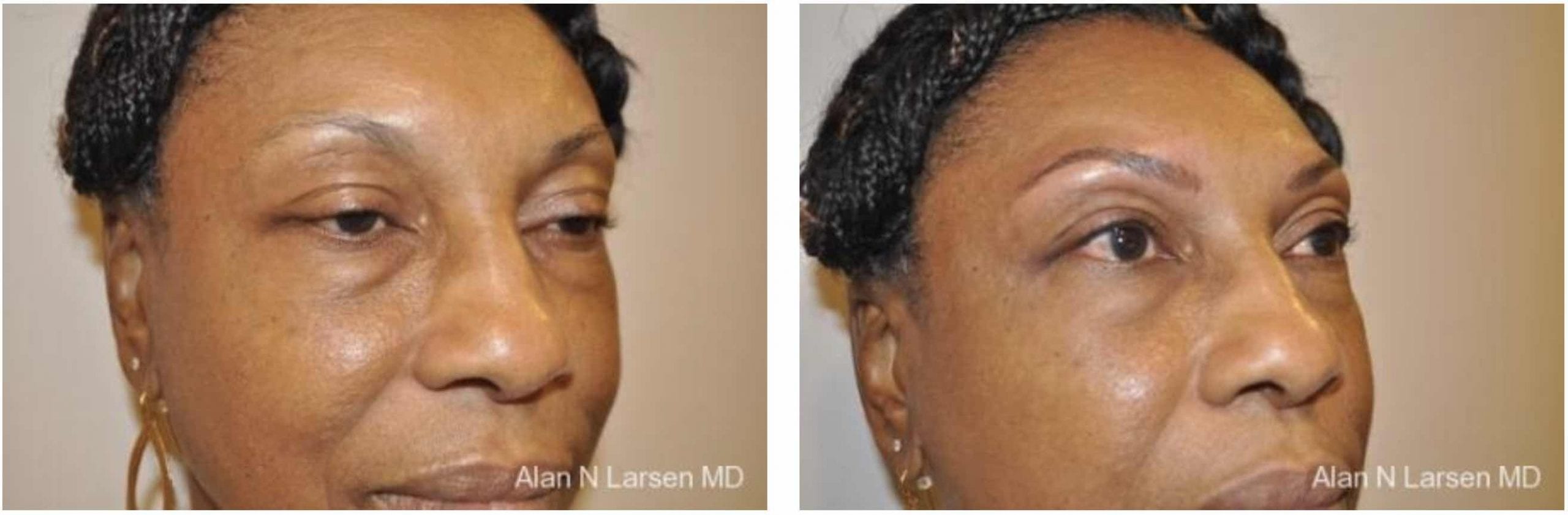 LUX Med Spa at Before and After Photo Gallery | Microblading | Buckhead Plastic Surgery | Alan N. Larsen, MD | Board-Certified Plastic Surgeon | Atlanta GA