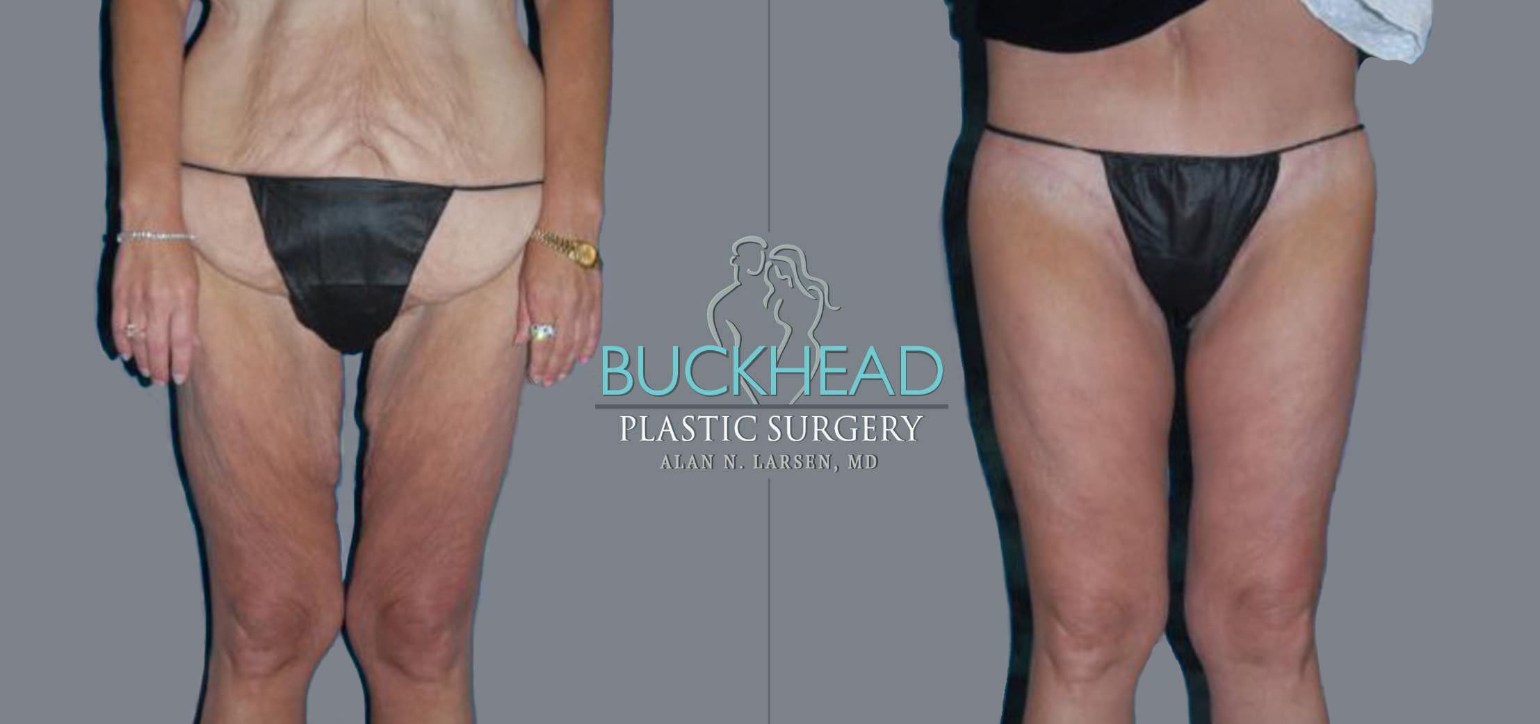 LUX Med Spa at Before and After Photo Gallery | Thigh Lift | Buckhead Plastic Surgery | Alan N. Larsen, MD | Double Board-Certified Plastic Surgeon | Atlanta GA