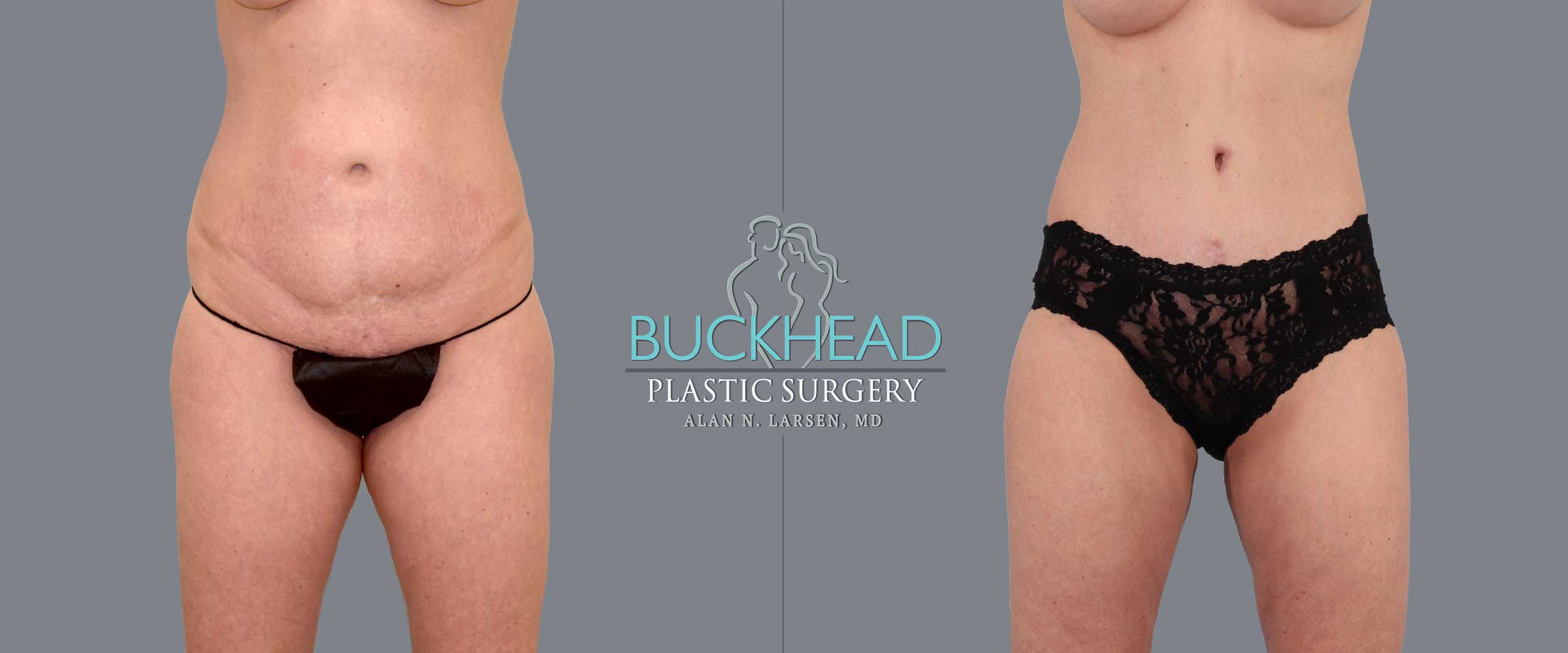 Alan N Larsen, MD, Double Board Plastic Surgeon at Buckhead Plastic Surgery