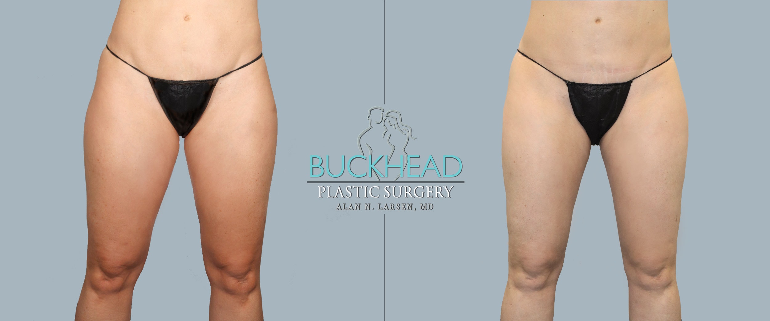 Before-and-After-Photo-Gallery-liposuction-Buckhead-Plastic-Surgery-Alan-N.-Larsen,-MD-Board-Certified-Plastic-Surgeon-Atlanta-GA-Inner-Thighs-Front