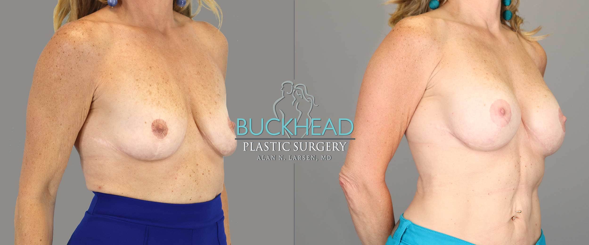 Before and After Photo Gallery | Breast Aug | Buckhead Plastic Surgery | Alan N. Larsen, MD | Board-Certified Plastic Surgeon | Atlanta GA