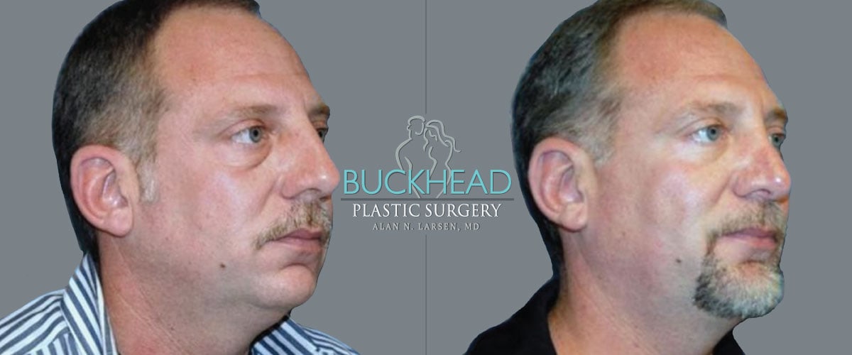 buckhead plastic surgery procedure alan n larsen dr md