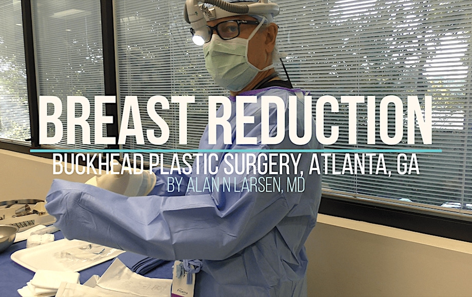 Before and After Photo Results | Breast Reduction | Buckhead Plastic Surgery | Board-Certified Plastic Surgeon in Atlanta GA