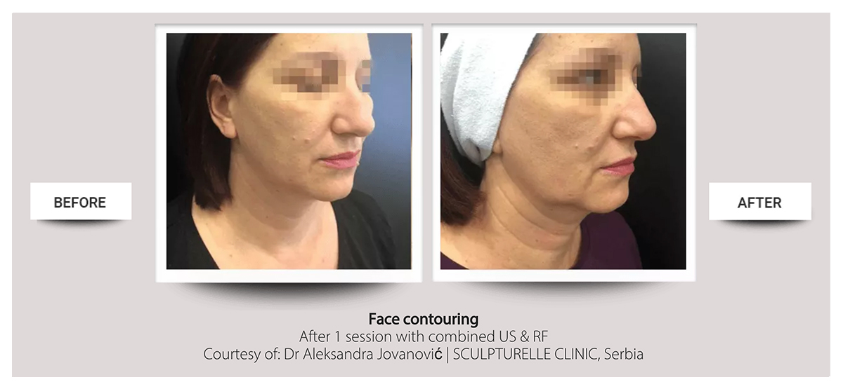 Accent Prime™ skin tightening, body contouring fast painless easy at Buckhead Plastic Surgery Atlanta GA