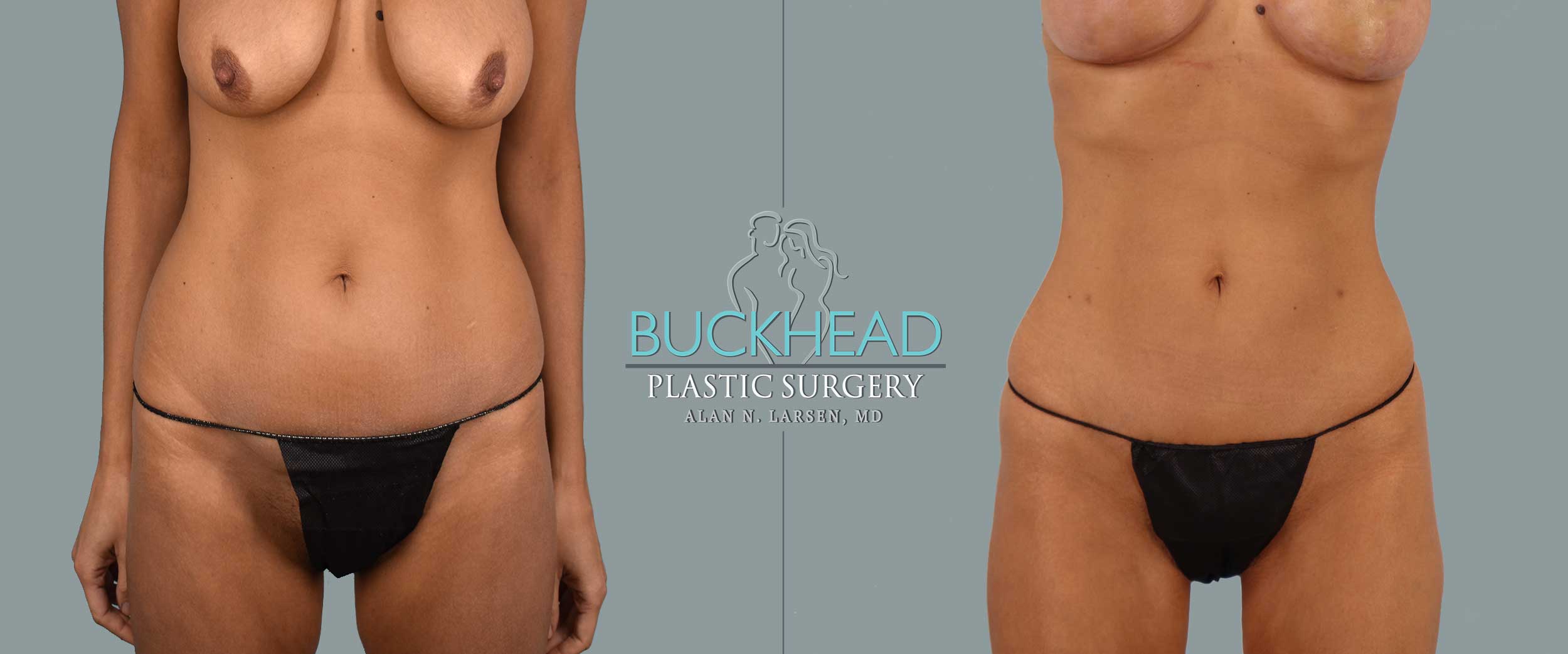 Alan N Larsen, MD, Double Board Plastic Surgeon at Buckhead Plastic Surgery