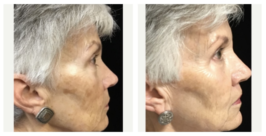 Opus Plasma at Buckhead Plastic Surgery in Atlanta offers visible results after as few as one treatment