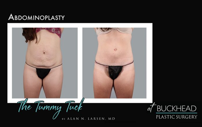 Before and After Photo Gallery | Tummy Tuck | Buckhead Plastic Surgery | Alan N. Larsen, MD | Board-Certified Plastic Surgeon | Atlanta GA