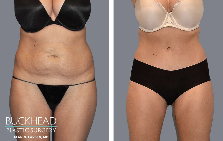 tummy tuck on the size of their waist. It’s especially common for women to be interested in this procedure after having children. The natural changes can leave you feeling less like yourself, and you might notice your clothes fitting differently. Although we believe all bodies are reasonable, we want you to feel confident when looking in the mirror. Sometimes a procedure like a tummy tuck can help you find the confidence you’re looking for.
