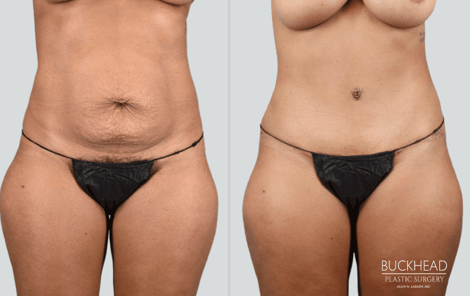 Which Tummy Tuck Is Right For Me?