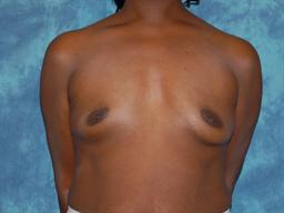 Breast Augmentation | Buckhead Plastic Surgery | Board-Certified Plastic Surgeon in Atlanta GA