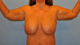 Breast Augmentation | Buckhead Plastic Surgery | Board-Certified Plastic Surgeon in Atlanta GA